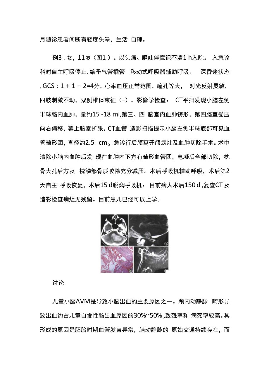 神经外科医师晋升副主任（主任）医师高级职称病例分析专题报告（儿童小脑出血急诊手术）.docx_第3页