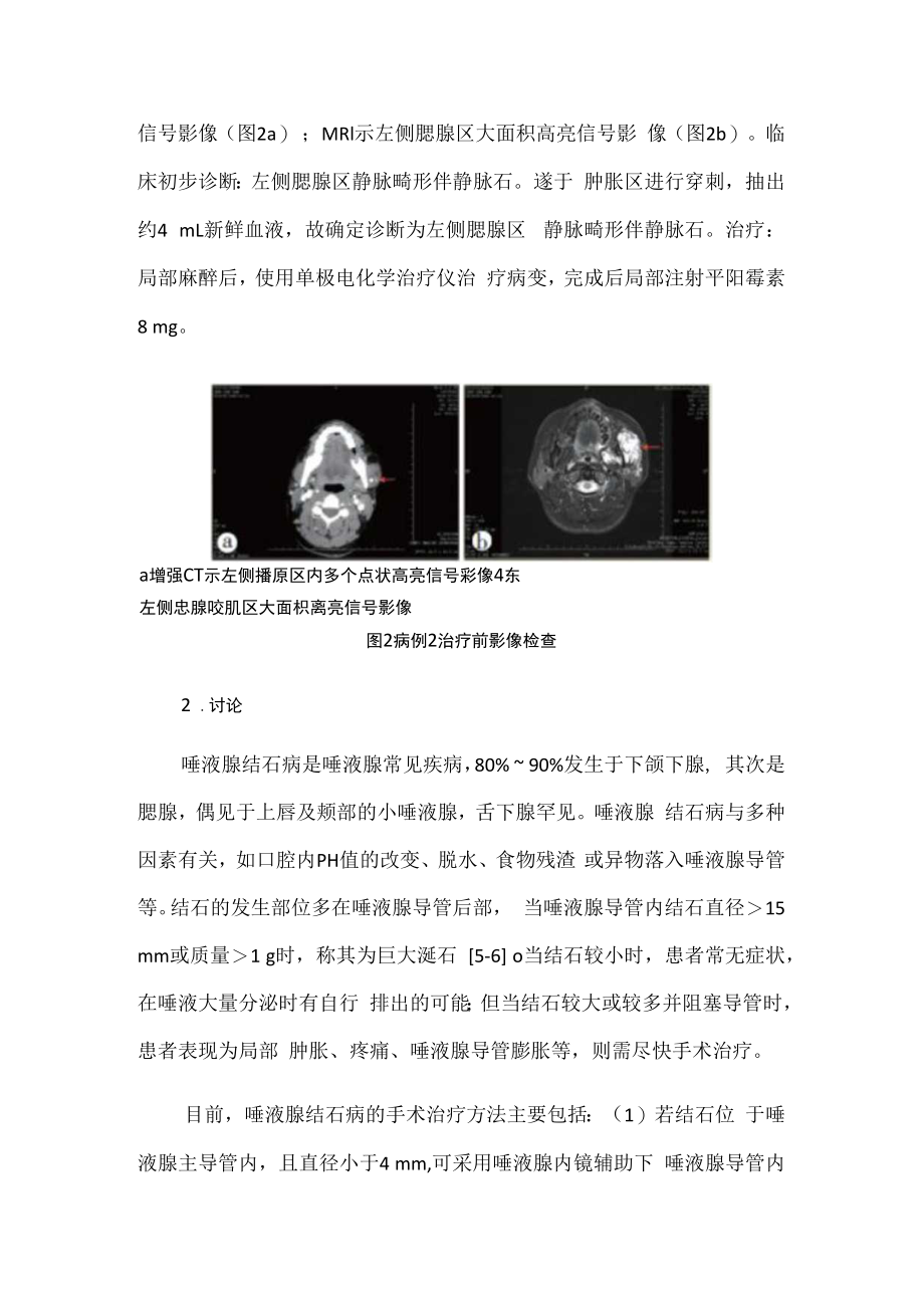 颌面部静脉畸形伴静脉石病例分析专题报告.docx_第3页