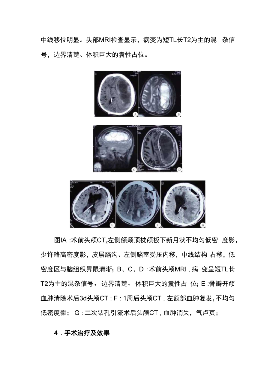 脑外科医师医师晋升副主任（主任）医师例分析专题报告（额颞顶枕部机化型慢性硬膜下血肿）.docx_第3页