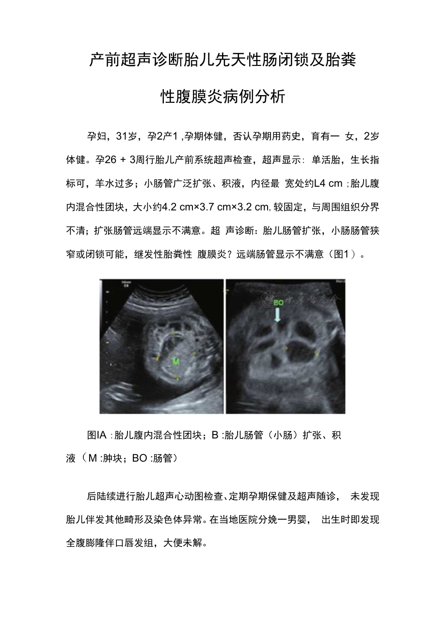 超声科医师晋升副主任（主任）医师例分析专题报告（产前超声诊断胎儿先天性肠闭锁及胎粪性腹膜炎）.docx_第2页