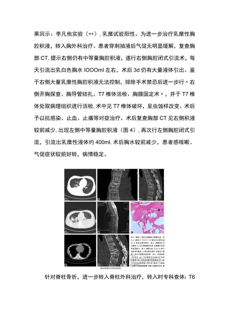 脊柱外科医师师晋升副主任医师专题报告病例分析（原发于胸椎Gorham-Stout综合征病例分析）.docx_第3页