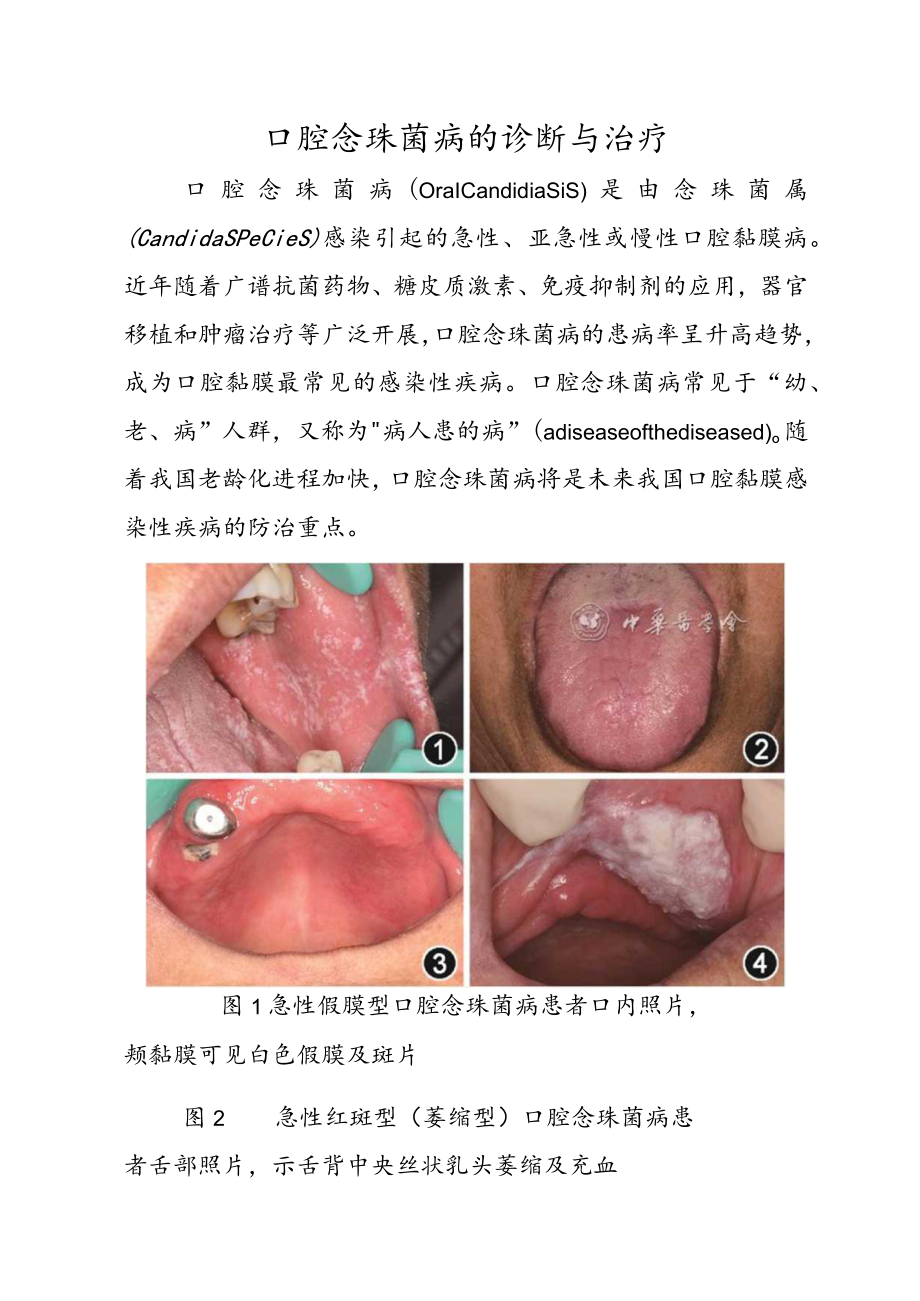 口腔念珠菌病的诊断与治疗.docx_第1页