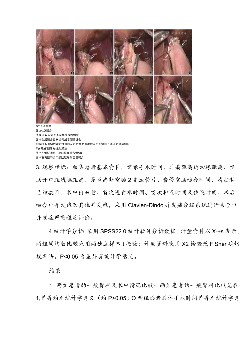 手工缝合在全腹腔镜食管胃结合部癌根治术消化道重建中的应用.docx_第3页