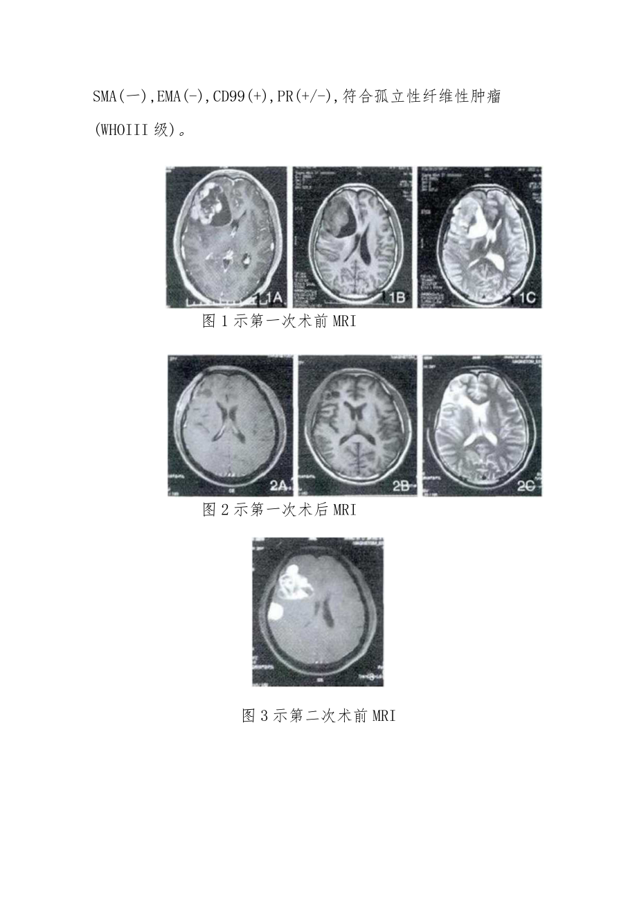 肿瘤科晋升副主任（主任）医师病例分析专题报告（多次复发颅内孤立性纤维瘤病例分析）.docx_第3页