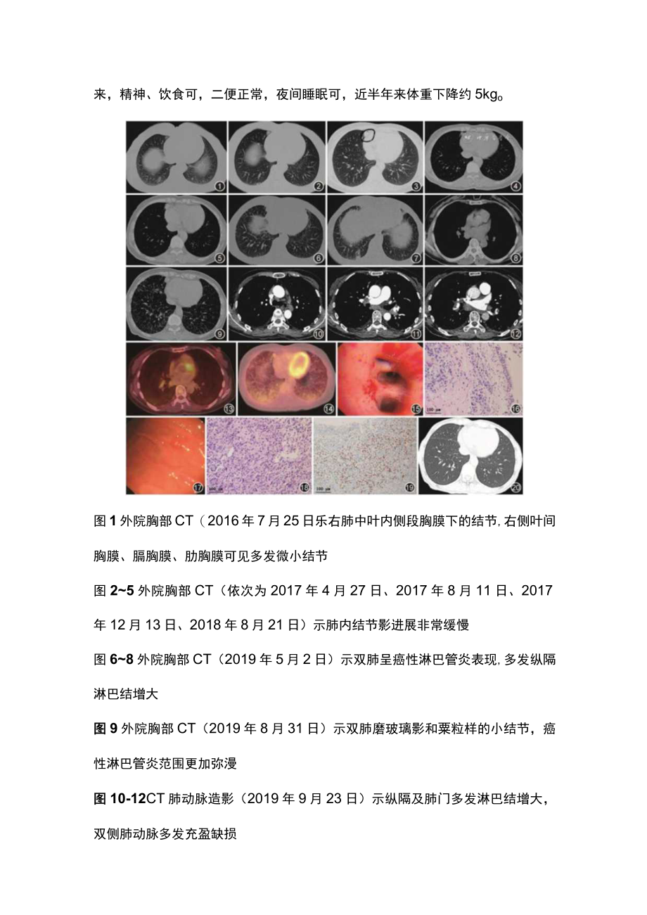 2022双肺多发结节伴间质性改变（全文）.docx_第2页