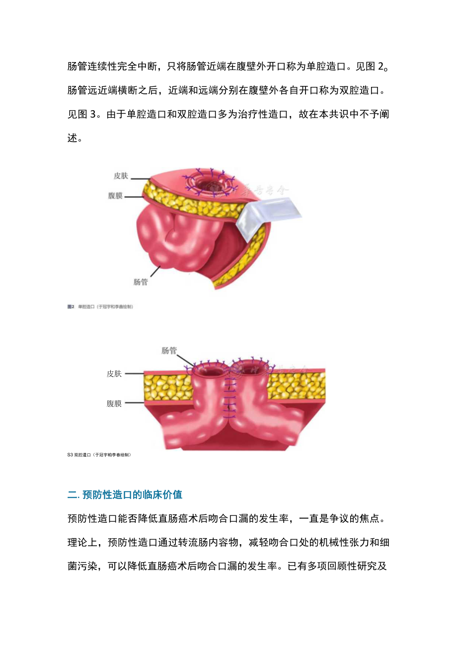 2022中低位直肠癌手术预防性肠造口中国专家共识（最全版）.docx_第3页