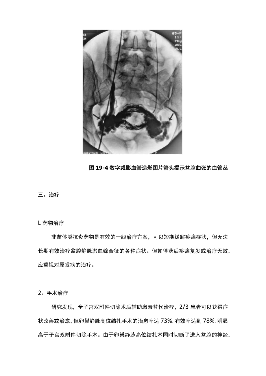 最新：盆腔静脉淤血综合征的临床诊治策略（全文）.docx_第3页