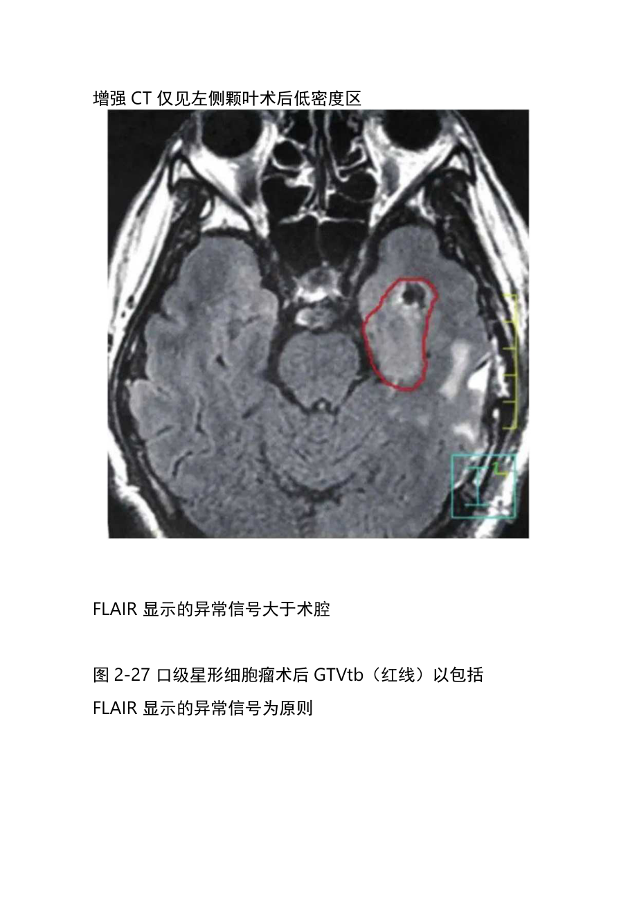 胶质瘤放疗靶区勾画.docx_第2页