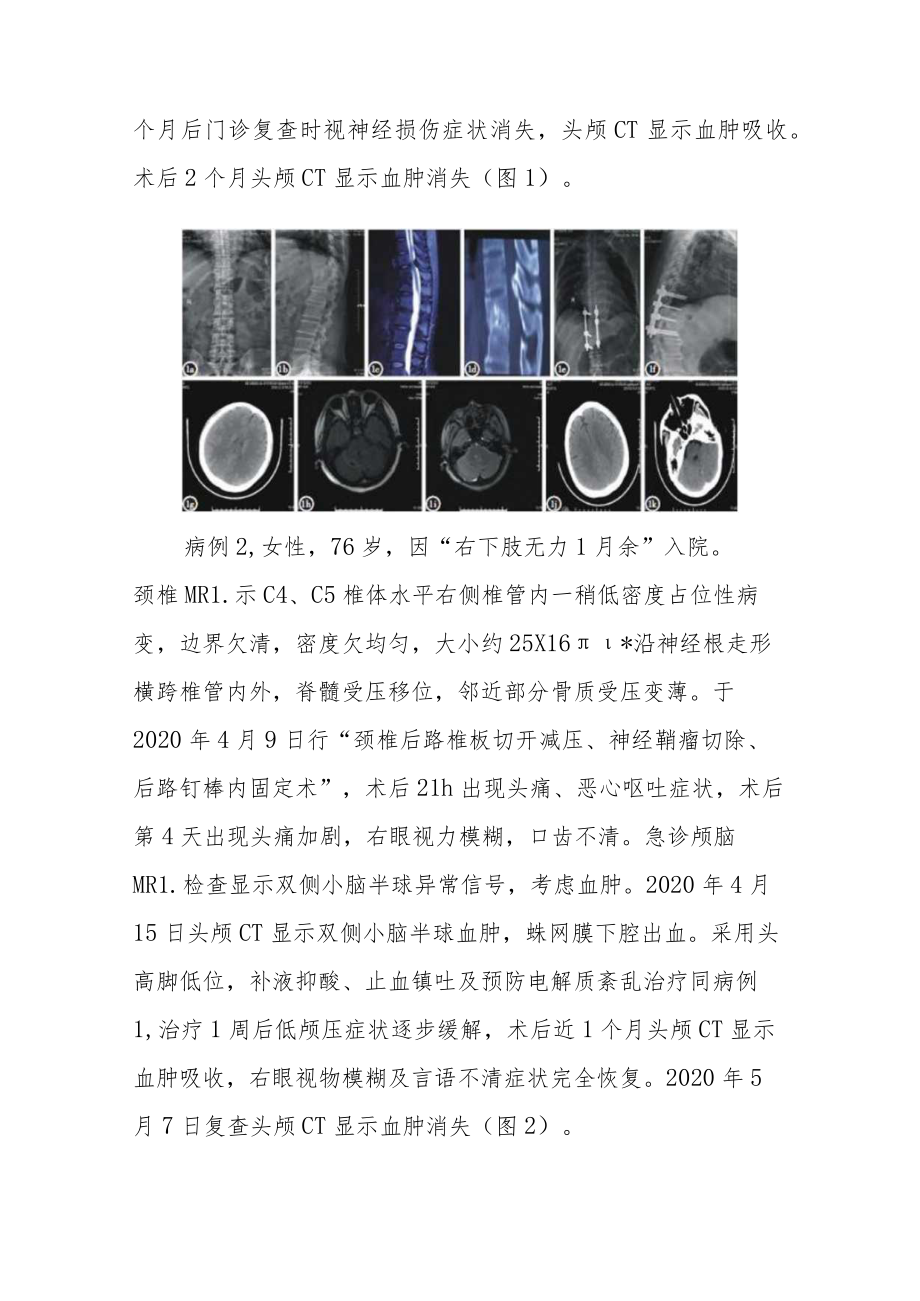 脊柱术后脑脊液漏伴颅内出血3例病例分析专题报告.docx_第2页