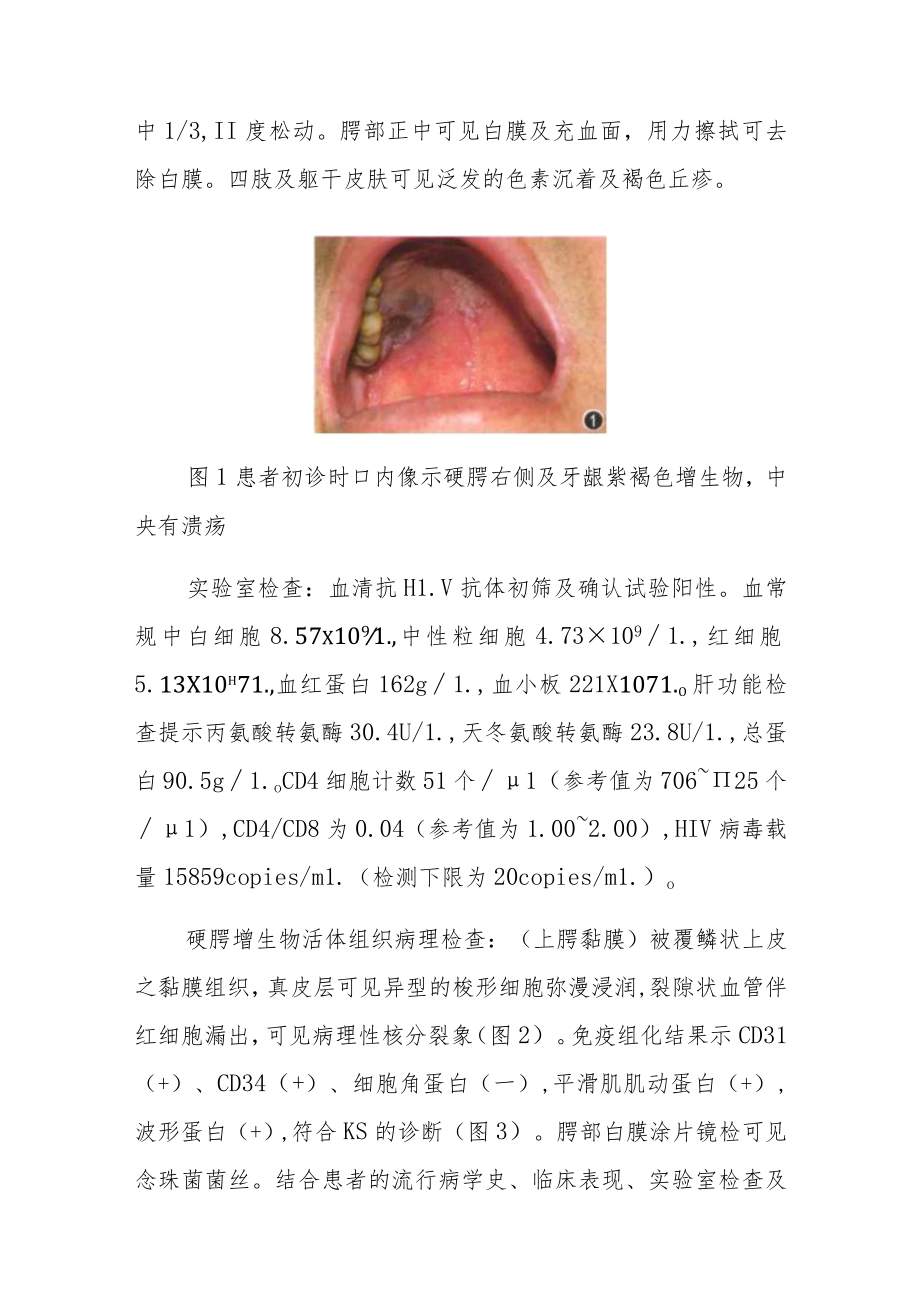 口腔科医师晋升副主任（主任）医师病例分析专题报告（AIDS相关卡波西肉瘤）.docx_第3页