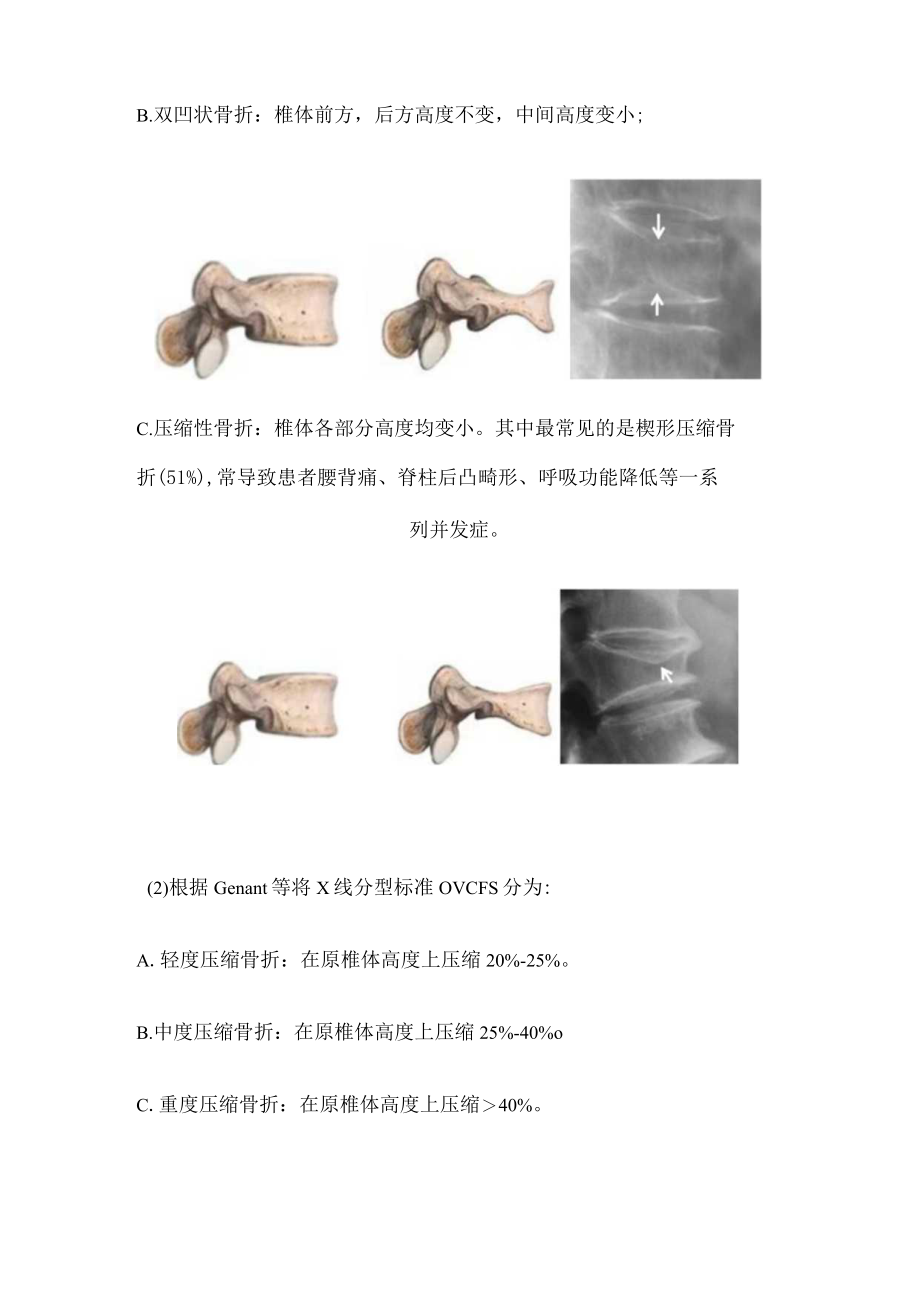 骨质疏松性椎体压缩骨折（全文）.docx_第2页