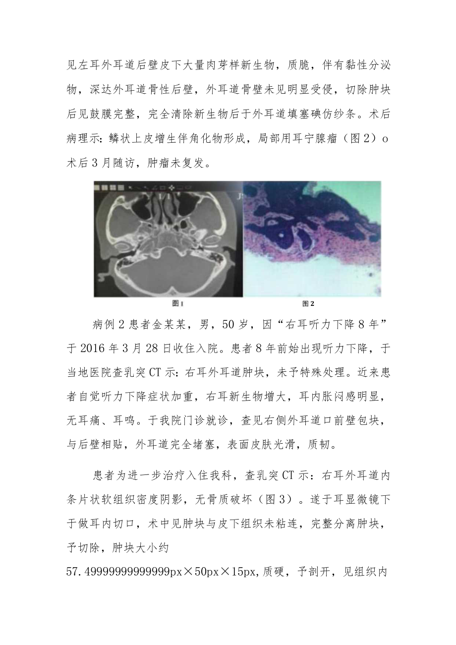 耳鼻喉科晋升副主任（主任）医师病例分析专题报告（外耳道耵聍腺良性肿瘤）.docx_第3页