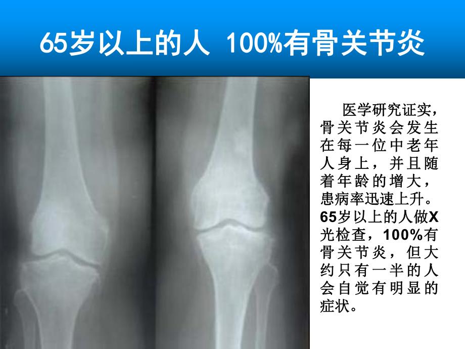 氨糖与骨关节病专家会销课件2.ppt_第3页