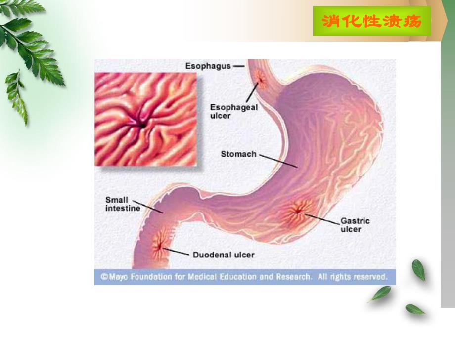 病例消化性溃疡名师编辑PPT课件.ppt_第2页