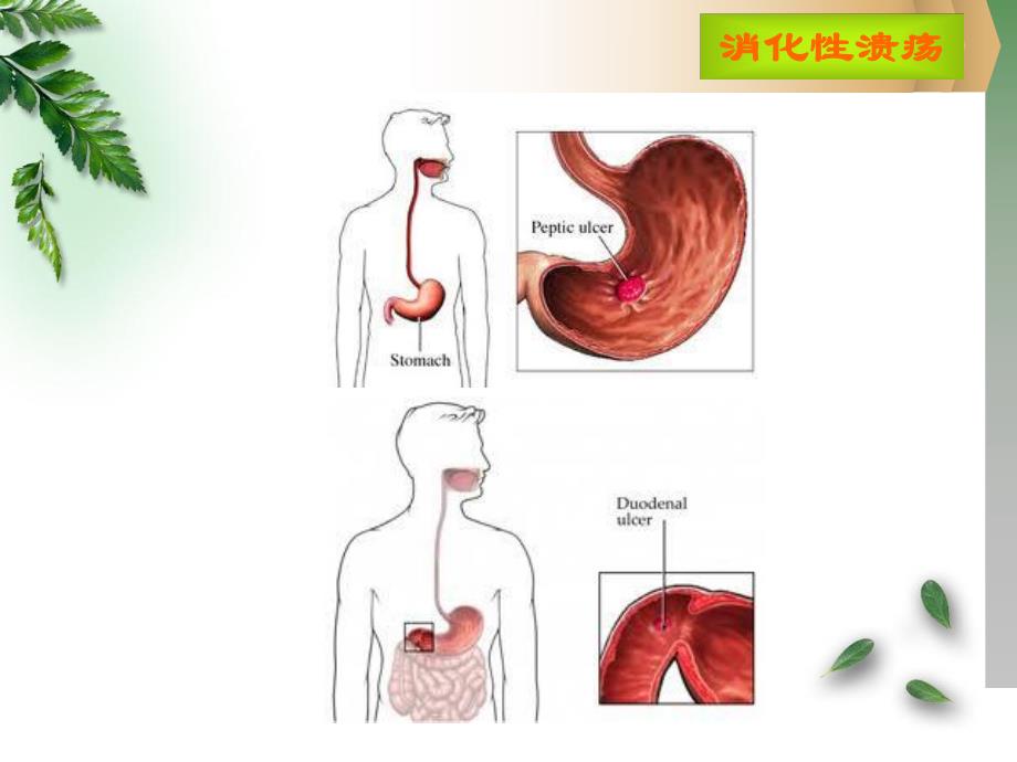 病例消化性溃疡名师编辑PPT课件.ppt_第3页