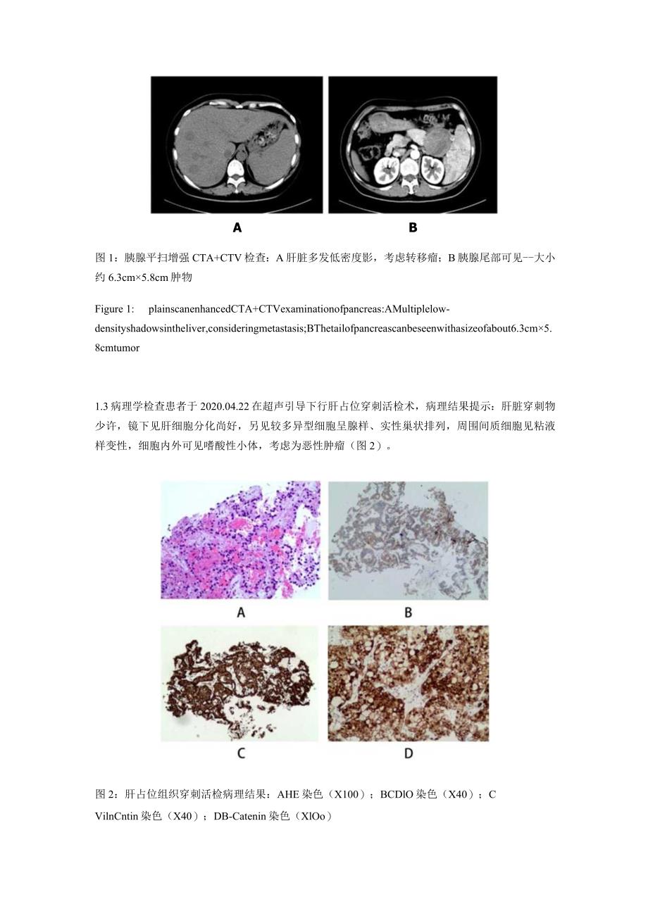 胰腺实性假乳头瘤伴肝转移1例并文献复习.docx_第2页