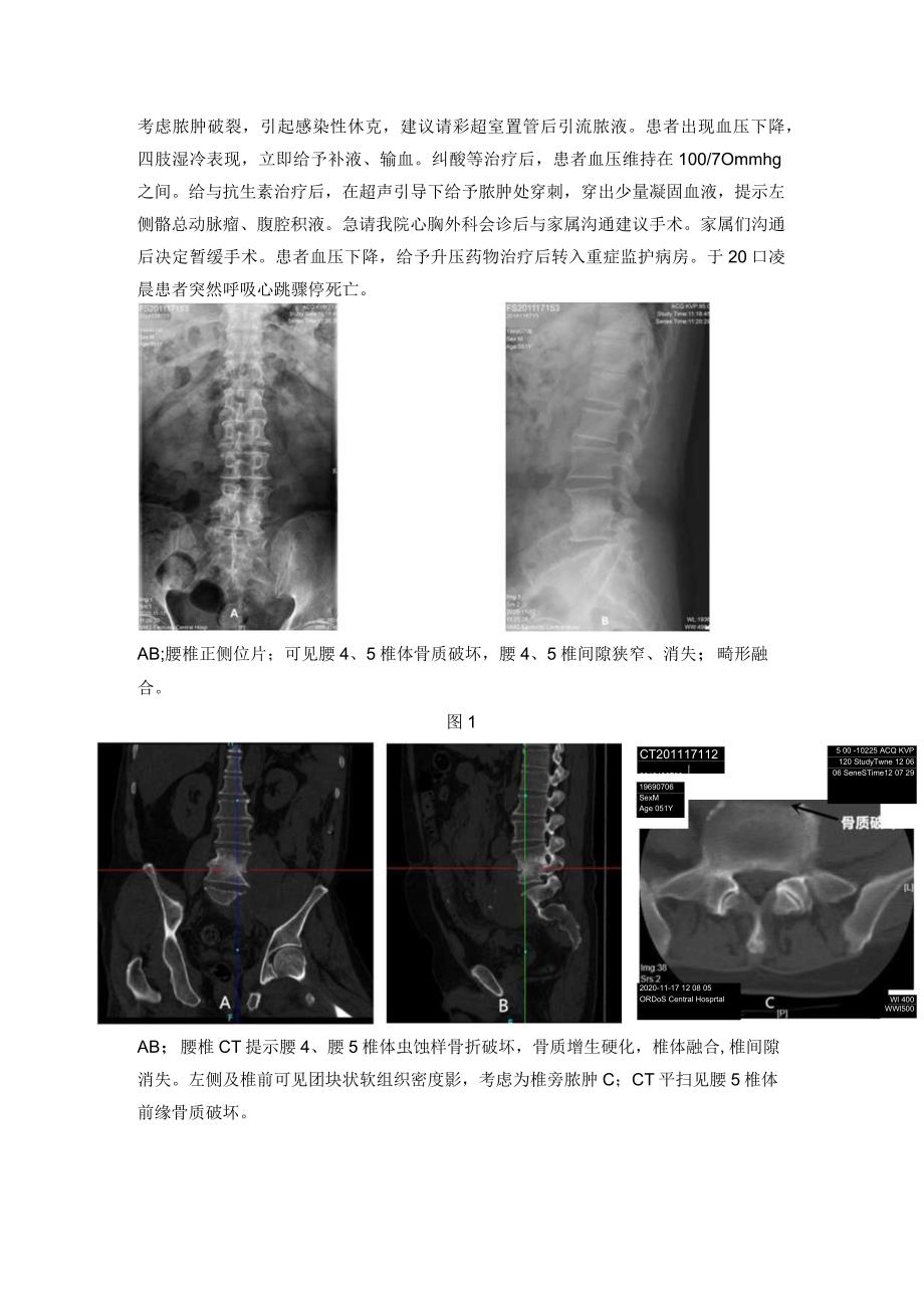 腰椎结核合并假性动脉瘤一例报道并文献复习.docx_第2页