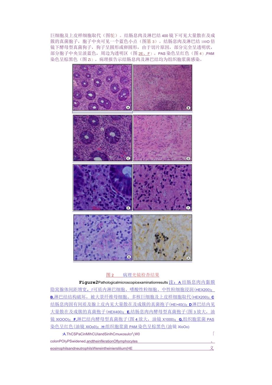 结肠及淋巴结组织胞浆菌病一1例并文献复习修改见批注！.docx_第3页