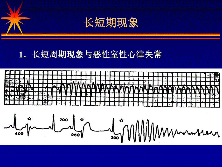 心律失常心电图的几个特殊现象名师编辑PPT课件.ppt_第3页