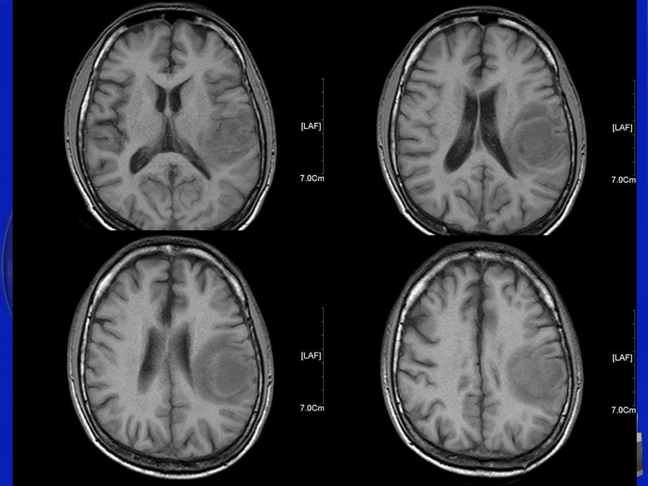 影像科经典读片之三脑淋巴瘤.ppt_第3页
