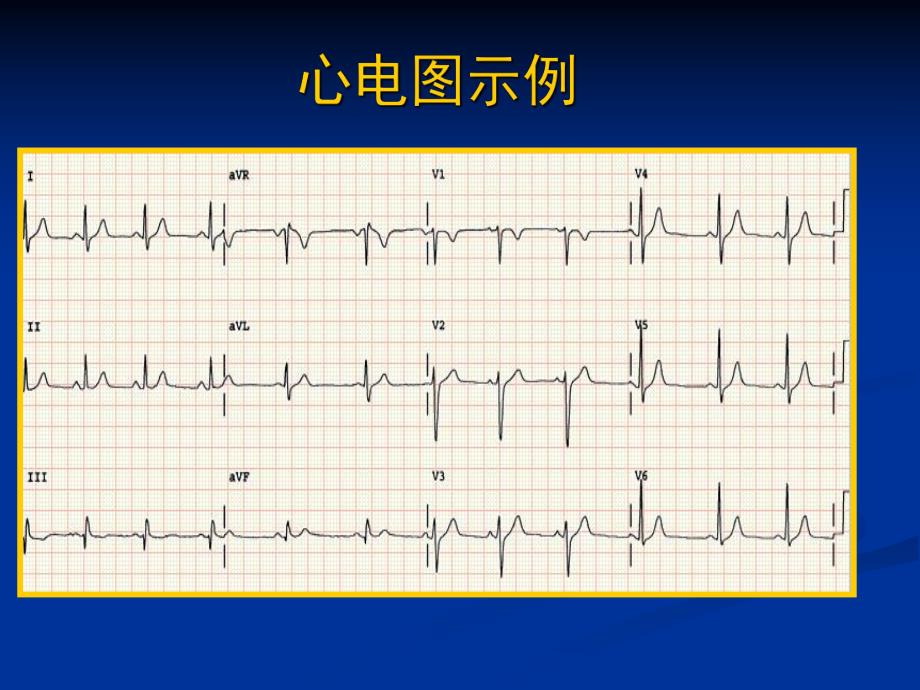 心电图1临床技能.ppt_第3页