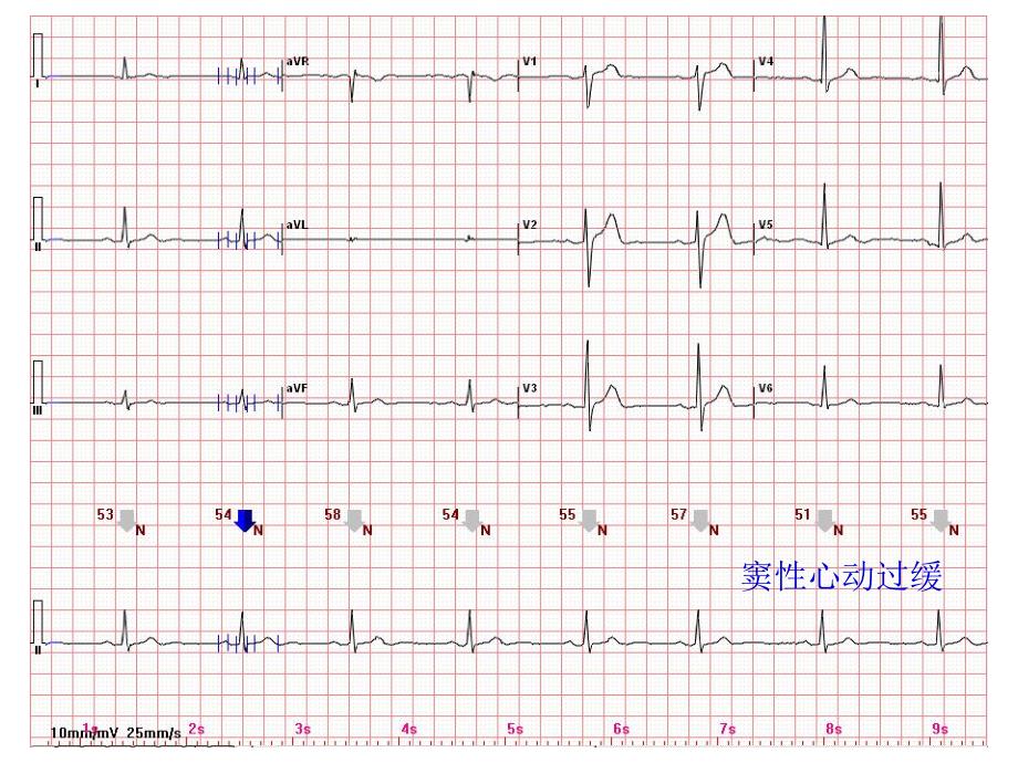 心电图常见正常和异常心电图图谱.ppt_第1页