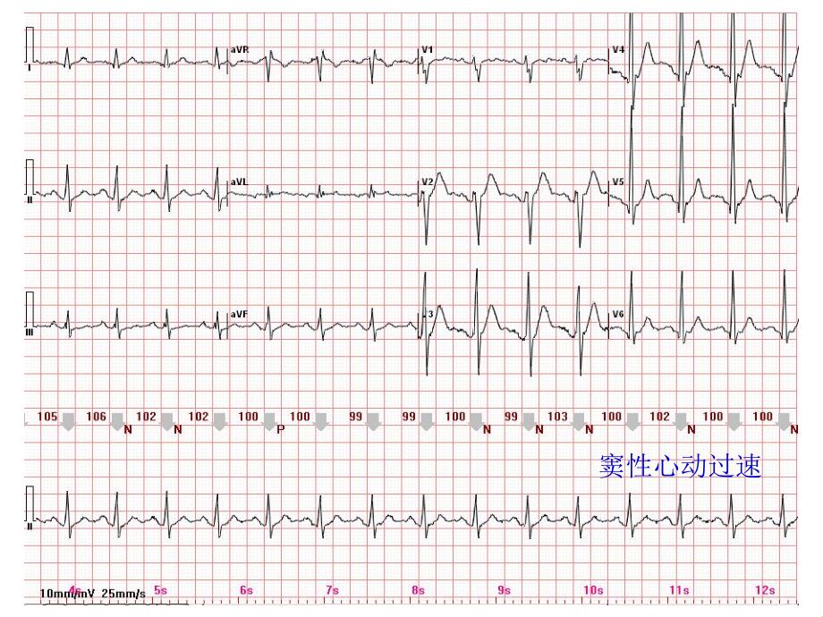 心电图常见正常和异常心电图图谱.ppt_第2页