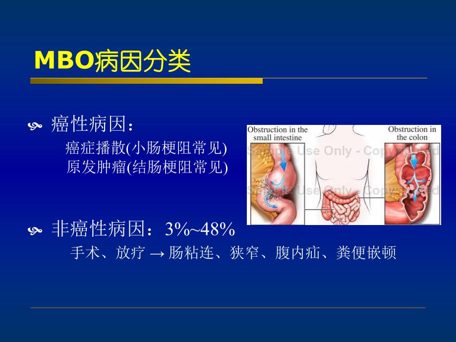 恶性肠梗阻.ppt_第3页