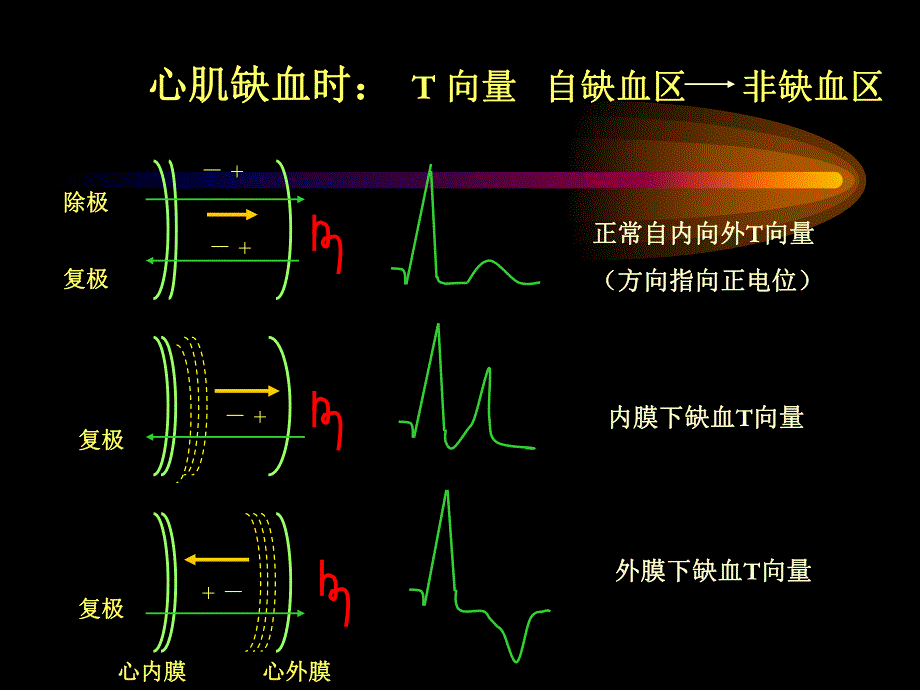 心肌缺血与心肌梗死的心电图改变.ppt_第3页