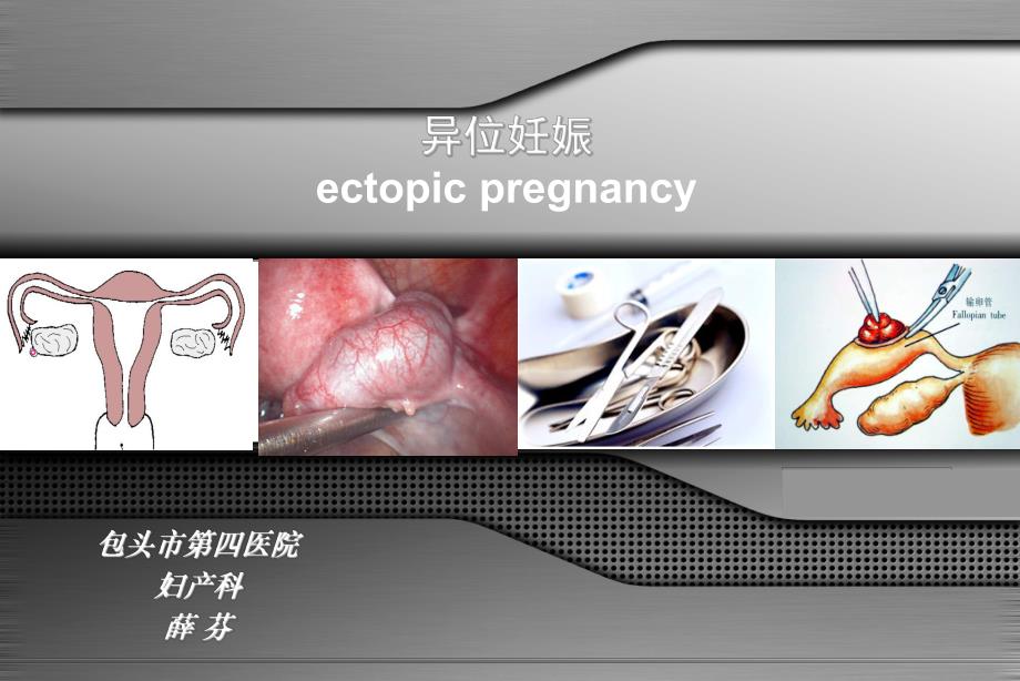 妇产科异位妊娠 .ppt_第1页