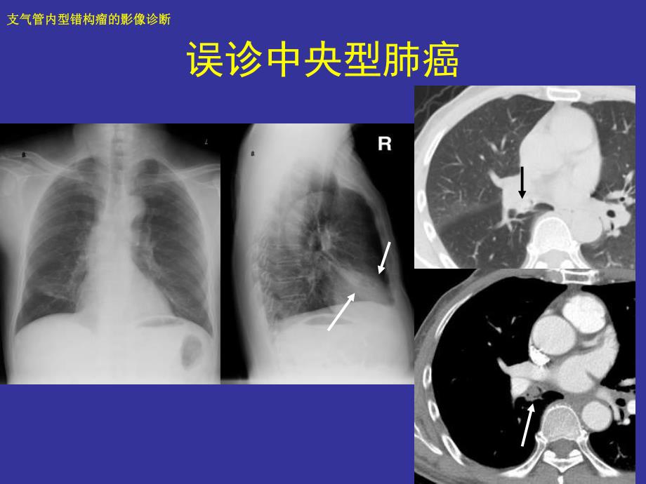 支气管内错构瘤的影像诊断.ppt_第3页