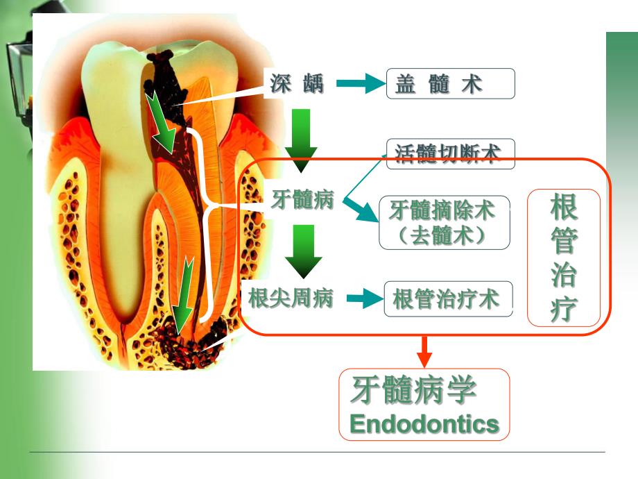 根管治疗rct.ppt_第2页