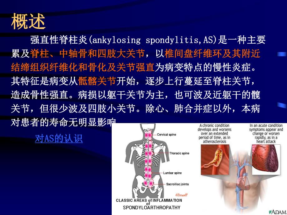 强直性脊柱炎1.ppt_第3页