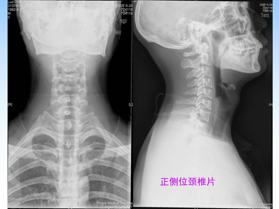 椎间盘病变.ppt_第3页