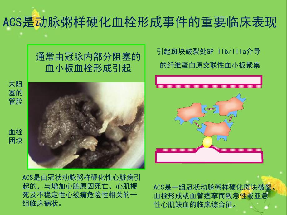 ACS抗栓治疗指南.ppt_第2页