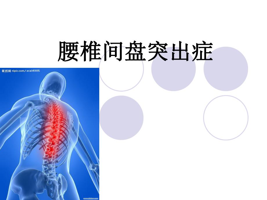 腰椎间盘突出症.ppt_第1页