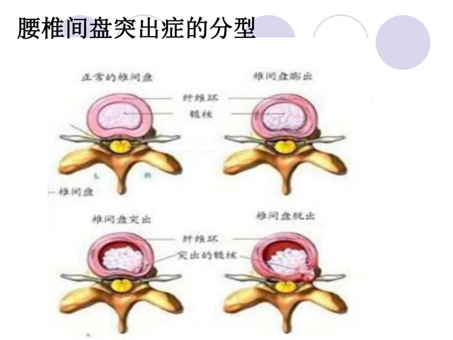 腰椎间盘突出症.ppt_第3页