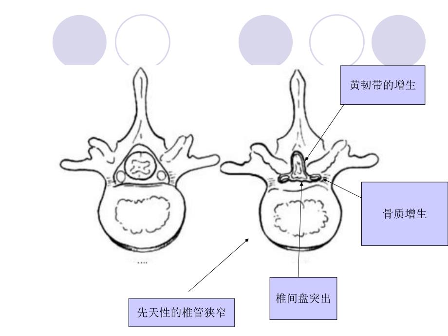 腰椎管狭窄症.ppt_第3页