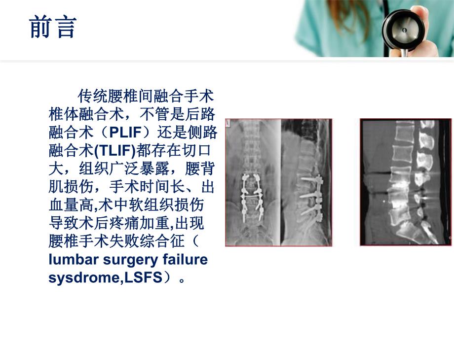 经皮腰椎融合术ppt.ppt_第3页