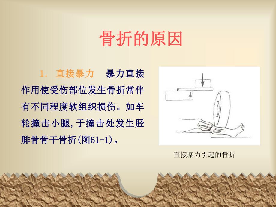 骨折的现场急救PPT.ppt_第3页