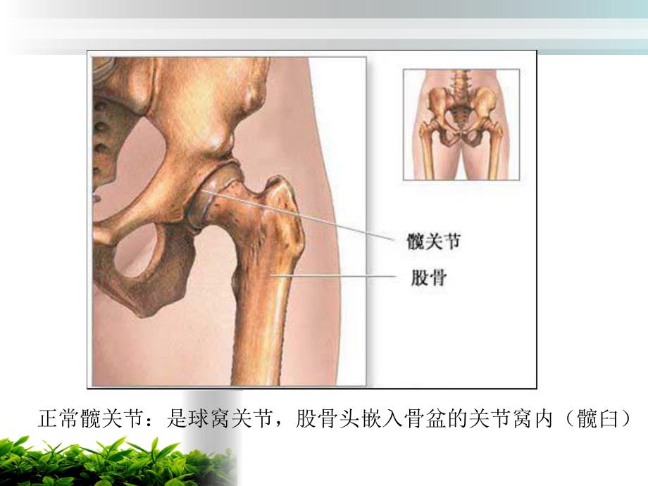 人工髋关节置换术后护理..ppt_第3页