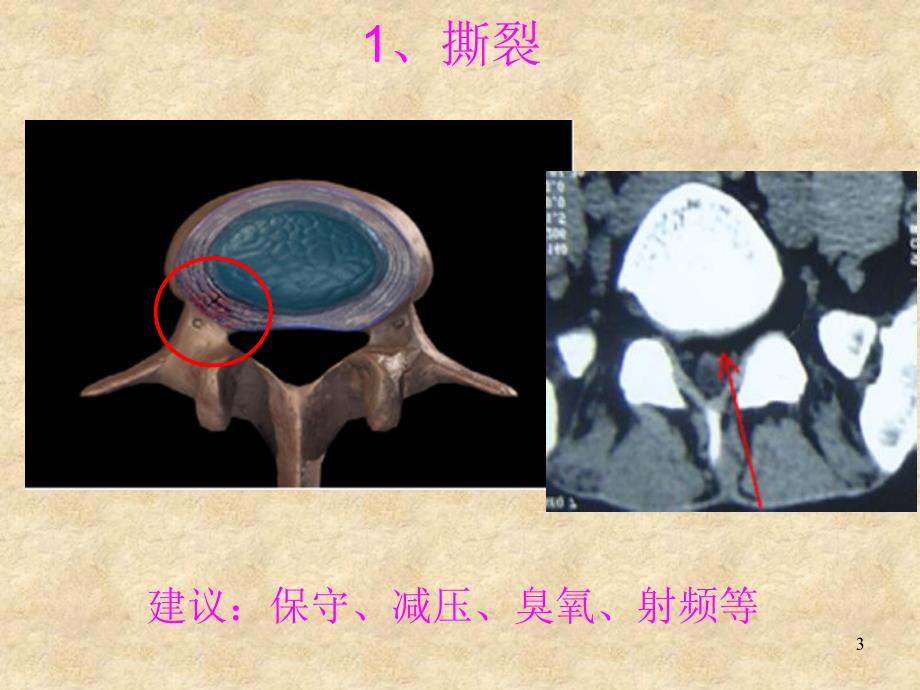 腰椎间盘突出症行椎间孔镜治疗与护理.ppt_第3页