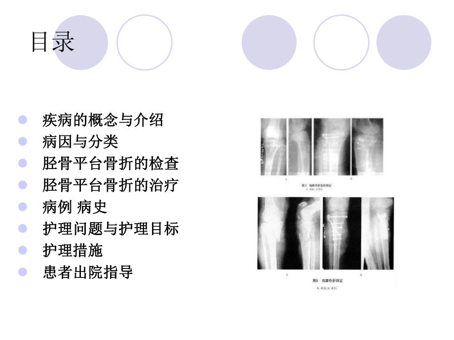 胫骨平台骨折的护理查房.ppt_第2页