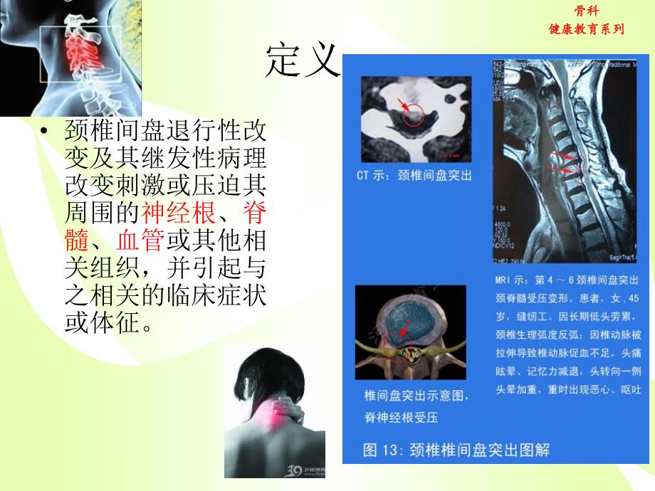 颈椎病健康教育.ppt_第2页