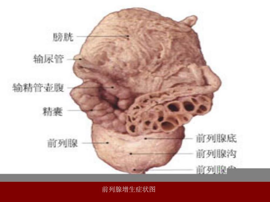 前列腺电切术的护理.ppt.ppt_第3页