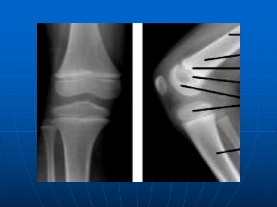 儿童骨关节损伤.ppt_第3页