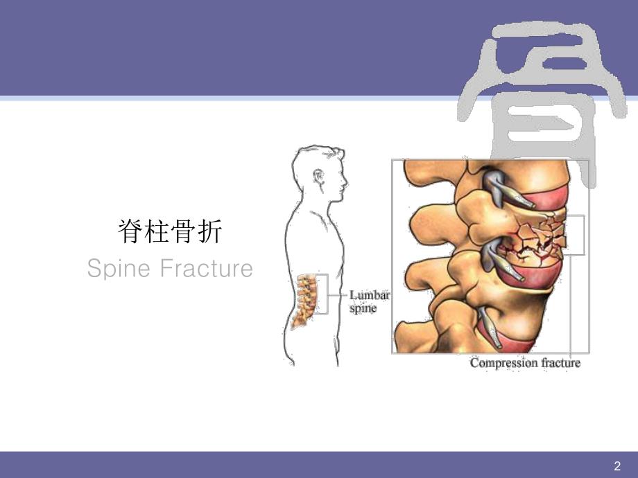 脊柱骨折.ppt_第2页