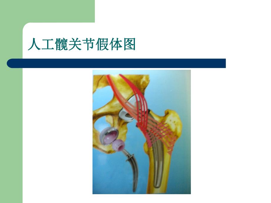 人工全髋关节置换术健康教育.ppt.ppt_第3页