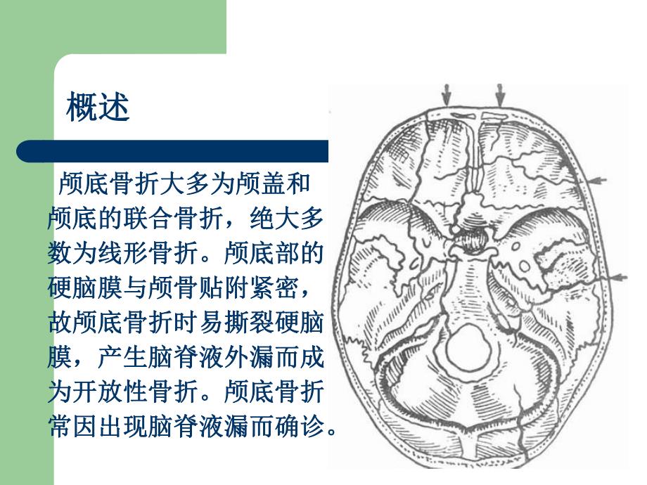 颅底骨折.ppt_第3页