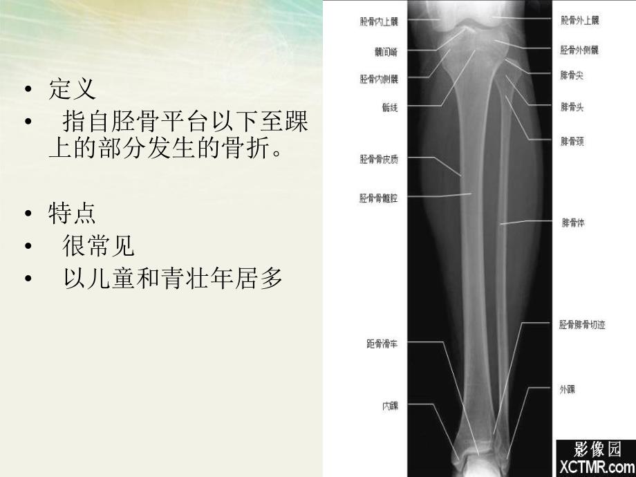 胫腓骨骨折的护理.ppt_第3页